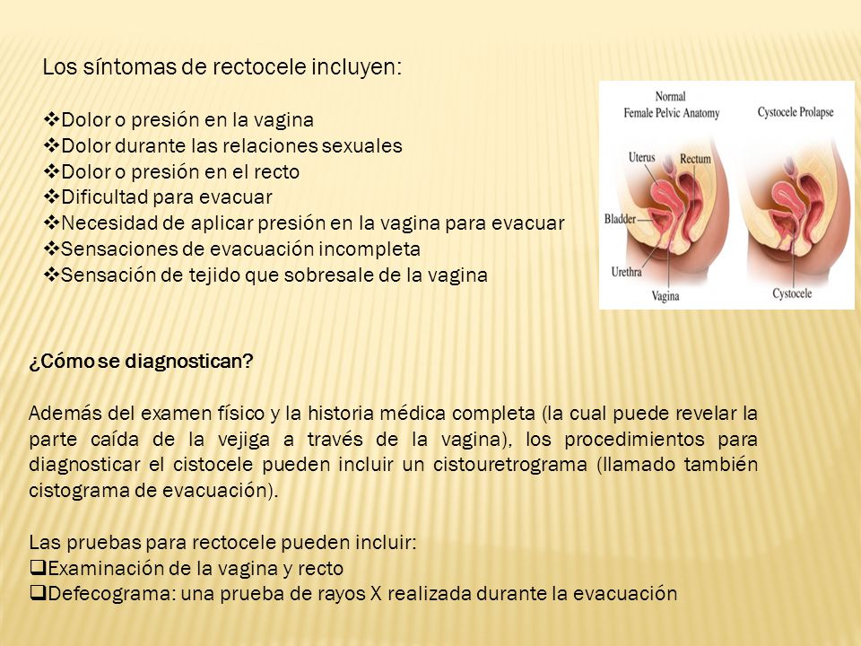Rectocele sintomas y causas